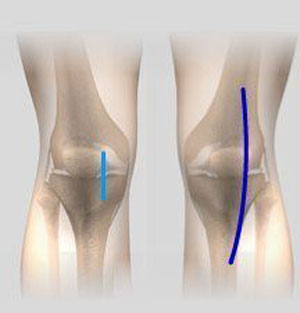 Minimally Invasive Knee Joint Replacement pic