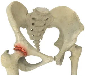 Osteoarthritis of the Hip pic