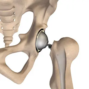 Total Hip Replacement pic