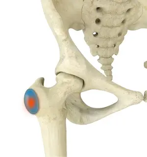 Trochanteric Bursitis pic