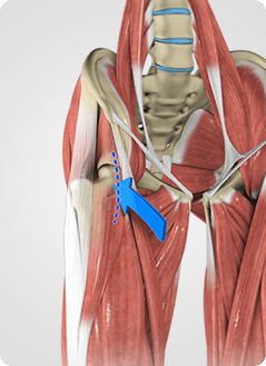 Anterior Hip Replacement Service Pic