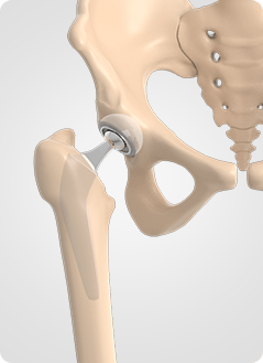 Hip Replacement Service Pic
