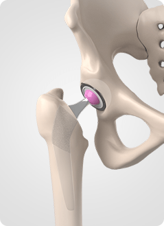 Revision Hip Replacement Service Pic