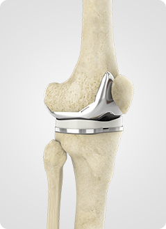 Revision Knee Replacement Service Pic