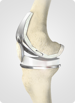 Total Knee Replacement Service Pic