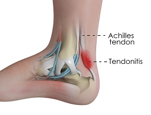 Achilles Tendinitis picture