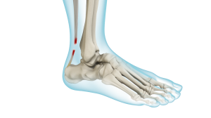 Achilles Tendon Rupture picture