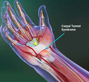 Carpal Tunnel Syndrome picture
