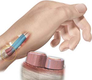 De Quervain's Tenosynovitis picture