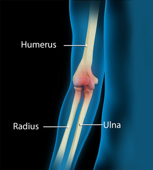 Elbow Pain picture