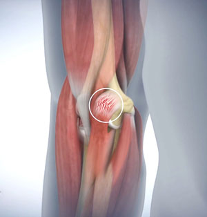 Golfer's Elbow picture