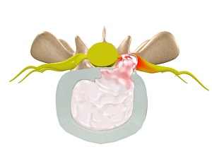 Herniated Disc picture