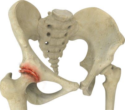 Hip Arthritis picture