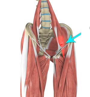 Hip Flexor Strain picture
