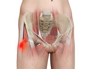 Hip Tendinitis picture