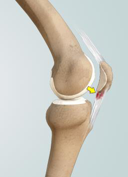 Knee Tendinitis picture