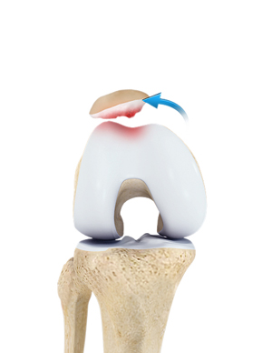 Patellofemoral Pain Syndrome picture