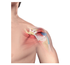 Rotator Cuff Injury picture