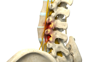 Spinal Stenosis picture