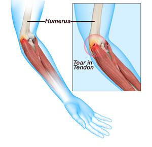 Tennis Elbow picture