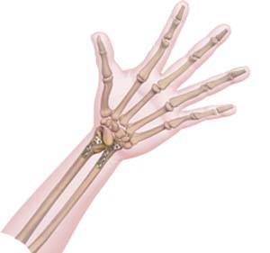 Wrist Fracture picture