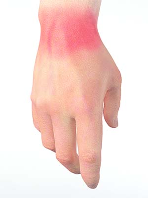 Wrist Sprain picture