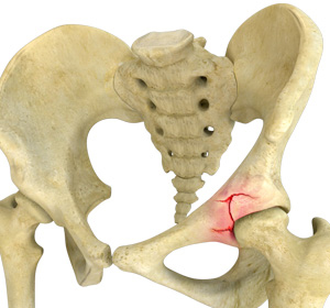 cAcetabuloplastyom - Educational Picture