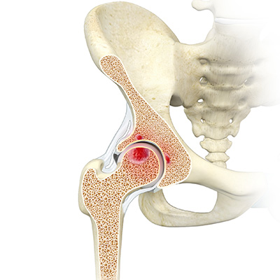 Acetabular Subchondral Cysts - Educational Picture