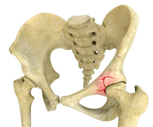 Acetabular Fracture - Educational Picture