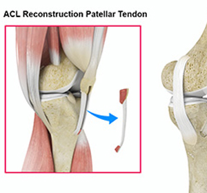 ACL Reconstruction - Educational Picture
