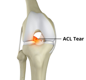 ACL Tears - Educational Picture