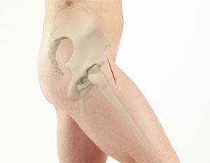 Anterior Hip Replacement - Educational Picture
