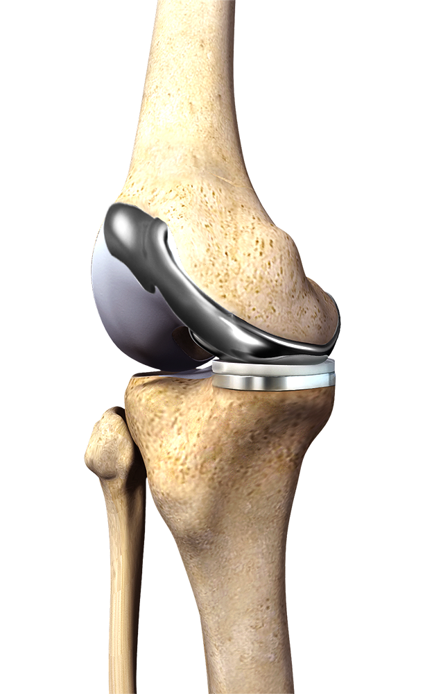 Arthritis Surgery - Educational Picture