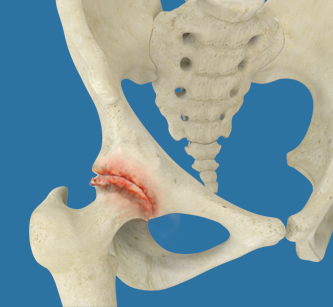 Arthritis - Educational Picture