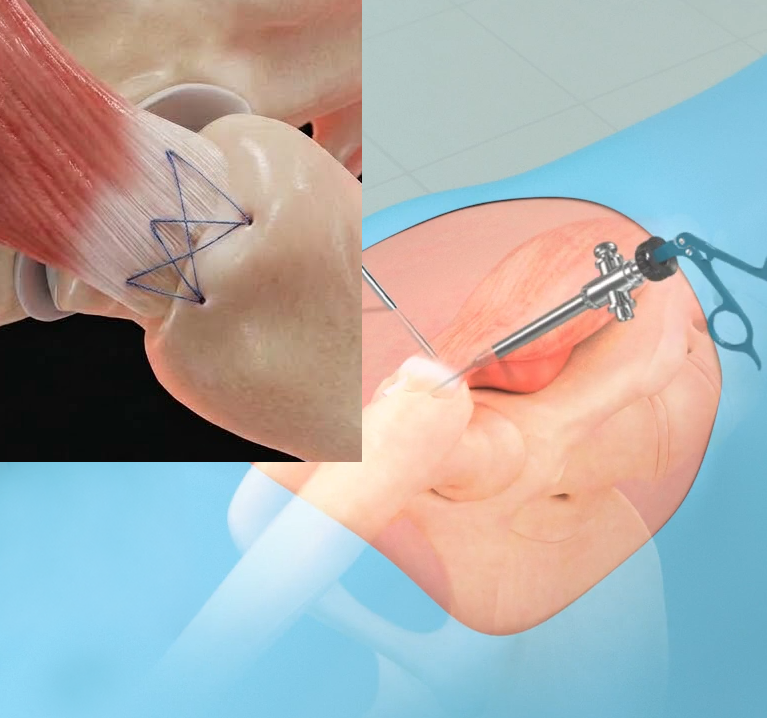 Arthroscopic - Educational Picture