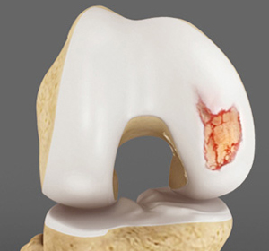 Articular Cartilage - Educational Picture