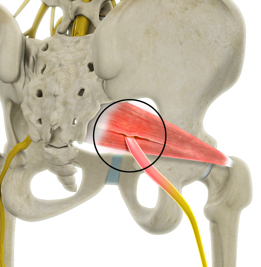 Deep Gluteal Pain Syndrome - Educational Picture