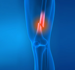 Distal Femur Fracture - Educational Picture