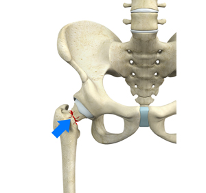 Femoral Neck Fracture - Educational Picture