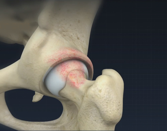 Femoral Osteoplasty - Educational Picture