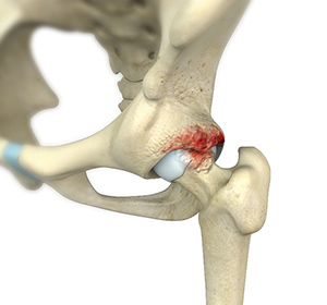 Femoroacetabular Impingement - Educational Picture