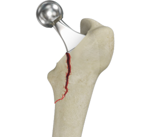 Femur Fracture - Educational Picture
