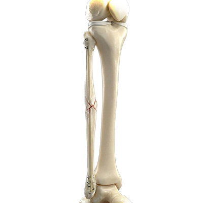 Fibula Fracture Care - Educational Picture