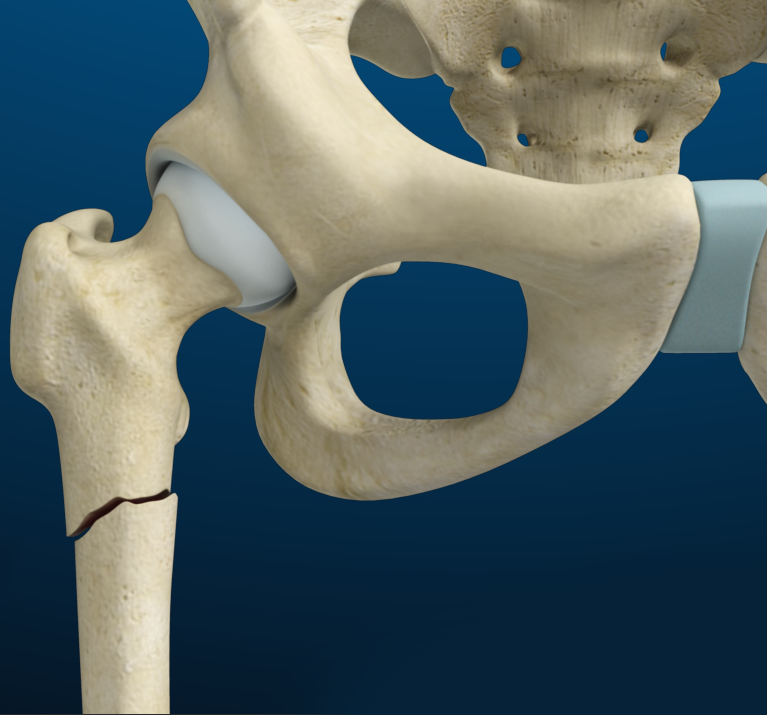 Fracture Care - Educational Picture