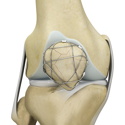 Fracture Repair - Educational Picture