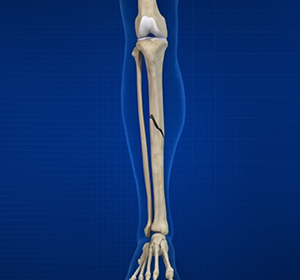 Fractures of the Tibia - Educational Picture