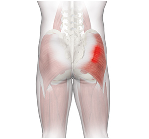 Gluteal Strain - Educational Picture