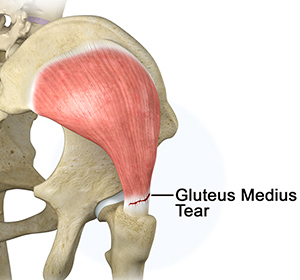 Gluteus Medius Tear - Educational Picture