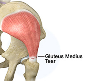 Gluteus Tendon Tear - Educational Picture