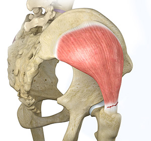 Hip Abductor Tears - Educational Picture